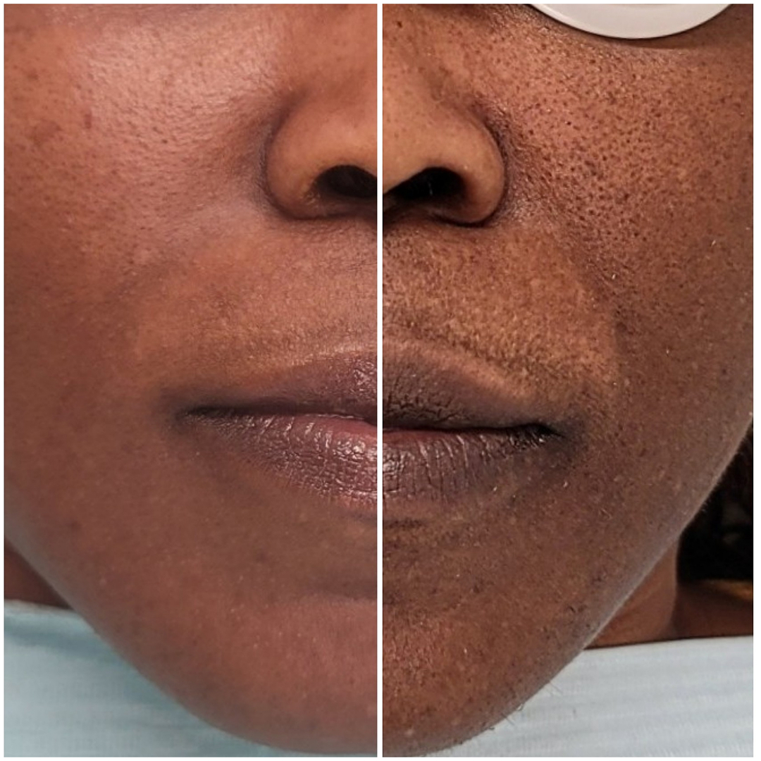 Pore tightening Facial