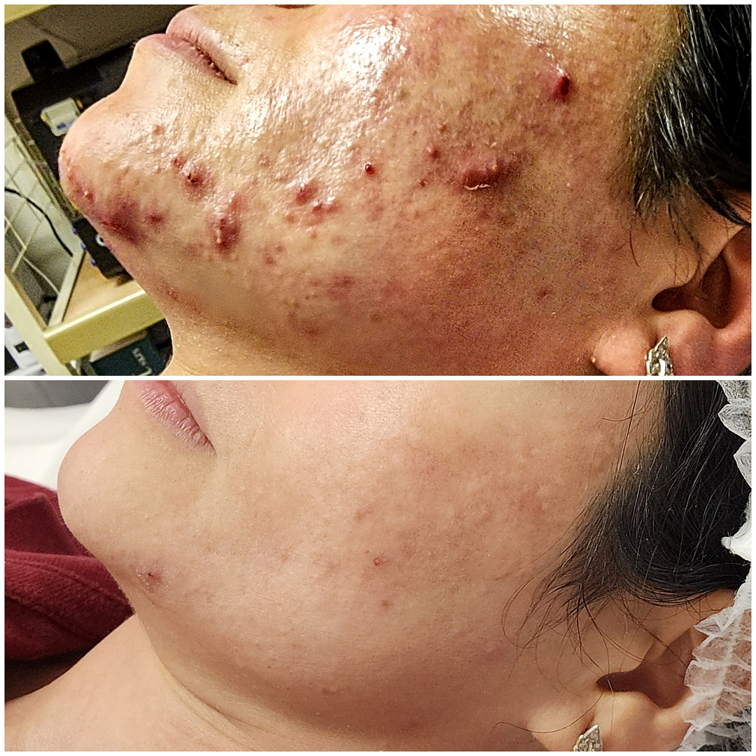 Cystic acne